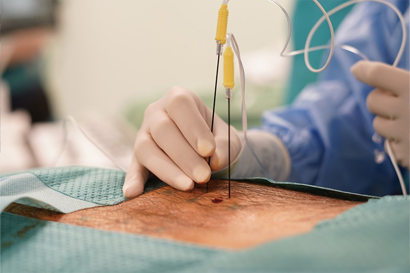 Radiofrecuencia térmica y pulsada